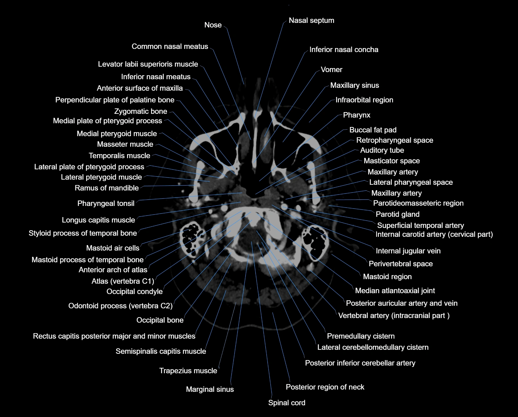 CT scan brain axial labelled cross sectional anatomy image-img-00001.webp